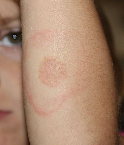 Lyme Disease Rash Child