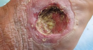 Maggot debridement therapy on a wound on a diabetic foot. Author: By Alexsey Nosenko / Maggot Medicine - Лечение ран личинками. Диабетическая стопа / Maggot debritment therapy. Diabetic foot, CC BY 3.0, https://commons.wikimedia.org/w/index.php?curid=46390555