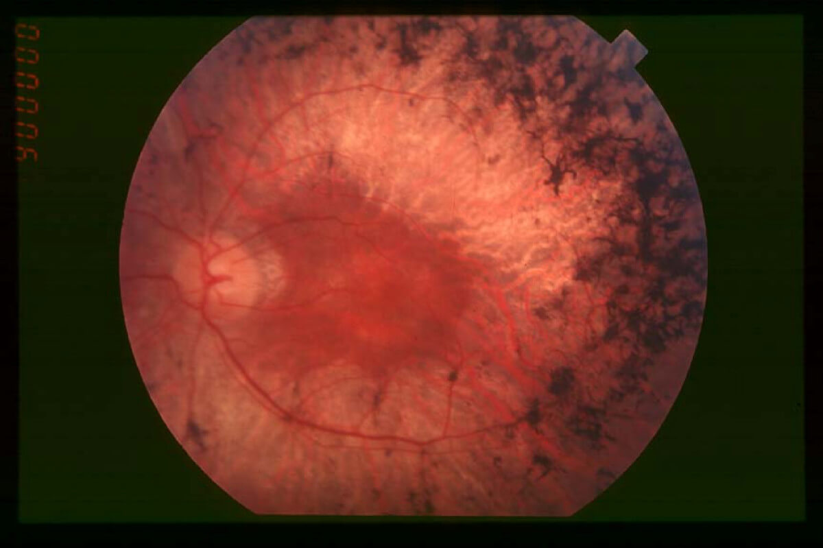 Fundus_of_patient_with_retinitis_pigmentosa,_mid_stage